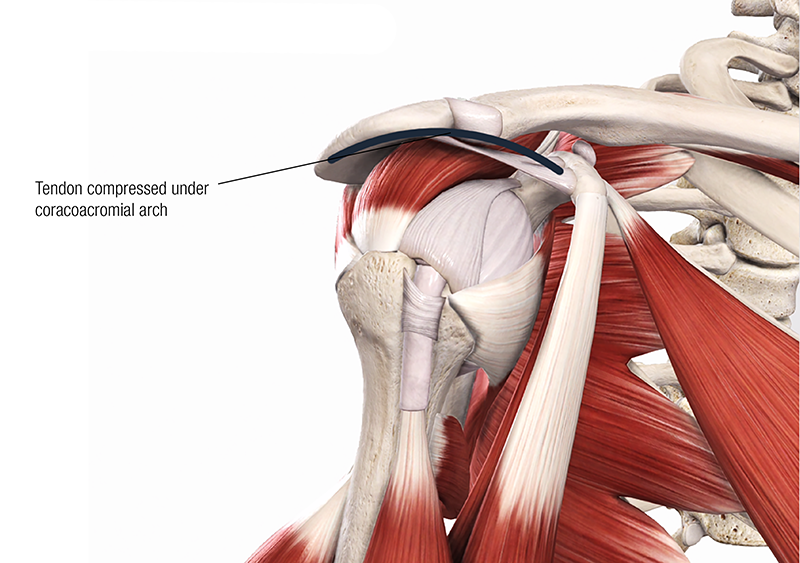 JA19_Bicipital Tendinopathy3