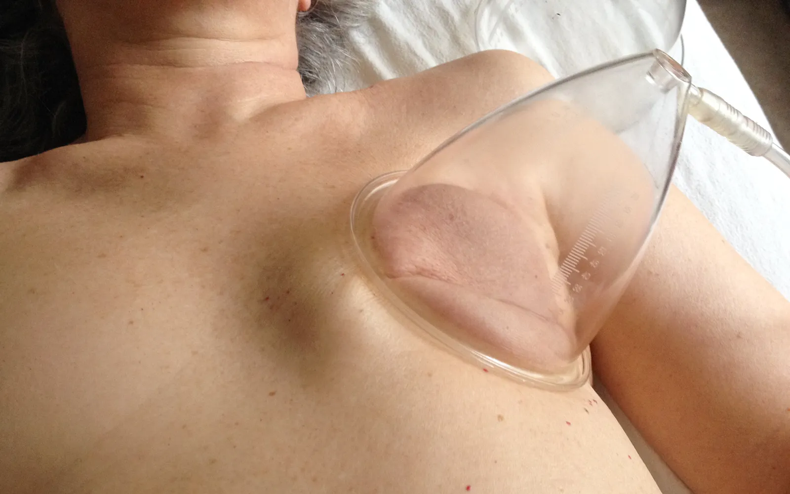 JA_16_VacuumManual_Secondary5_masectomy_1600 JA_16_VacuumManual_Secondary5_masectomy_1600