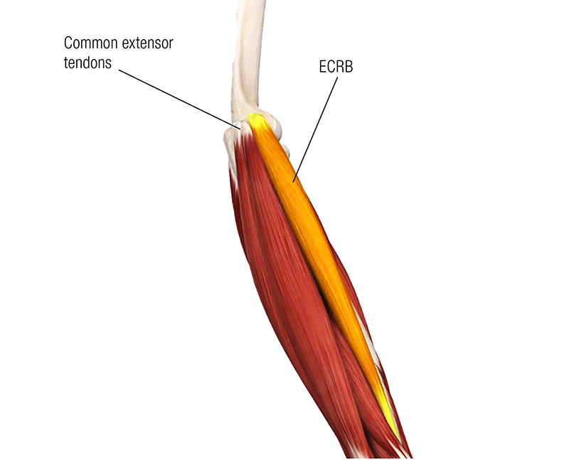 SO19_Current Views on Lateral Epicondylitis SO19_Current Views on Lateral Epicondylitis