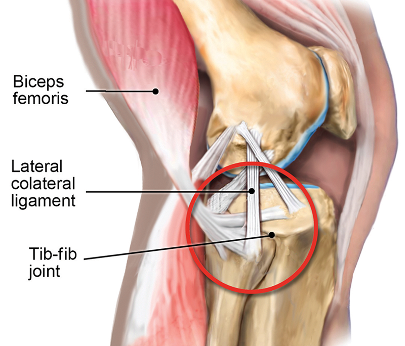 MJ20_Superior TibFib