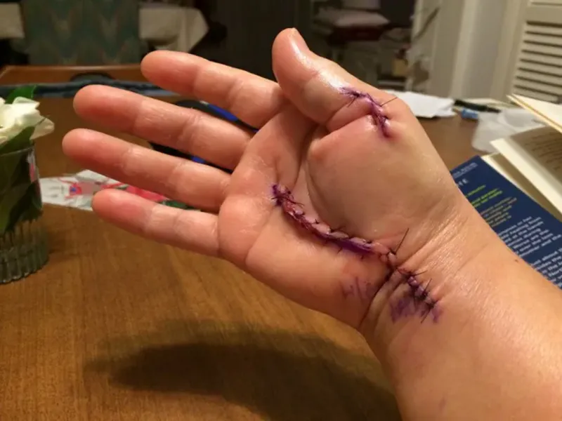 JA20_scars carpal JA20_scars carpal