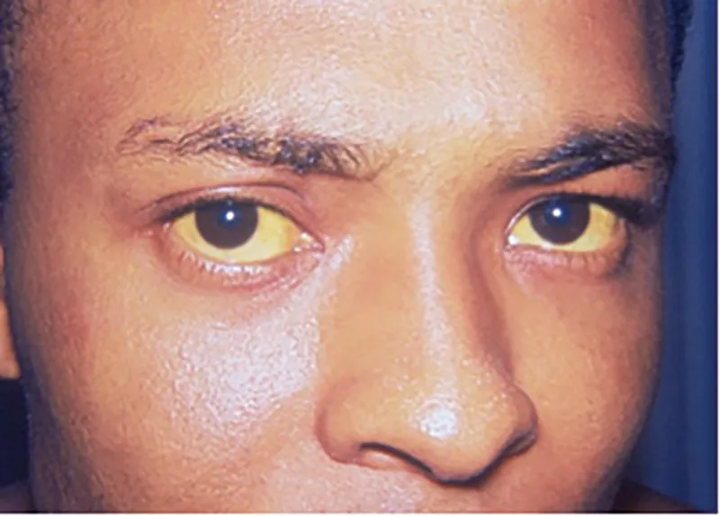 MA_15_Pathology2_jaundice_800px