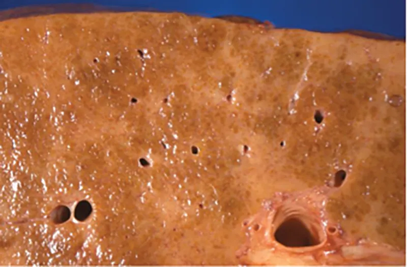 MA_15_Pathology1_liver_800px